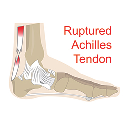 Average American Male Adult More at Risk for Achilles Tendon