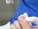 Orthonyx Bracket; podiatrist puts a toenail clamp on an ingrown toenail.